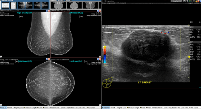 Diagnostic Breast Imaging 第2版 Diagnostic breast imaging : mammography, sonography